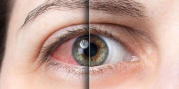 Uzmanı uyardı: Göz alerjisi ile göz enfeksiyonunu karıştırmayın