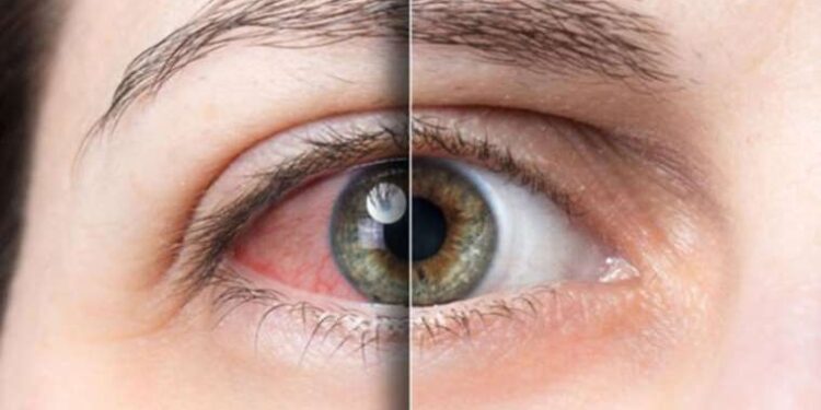 Uzmanı uyardı: Göz alerjisi ile göz enfeksiyonunu karıştırmayın