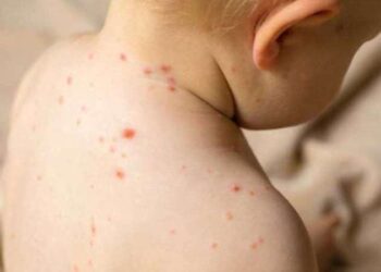 Çocuklarda artan el, ayak ve ağız hastalıklarına dikkat!