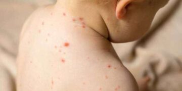 Çocuklarda artan el, ayak ve ağız hastalıklarına dikkat!