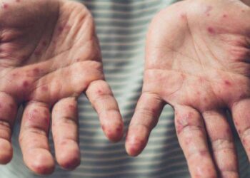 Kızamıkta 'kış' endişesi: Canan Karatay gibiler yüzünden çocuklar aşılatılmıyor