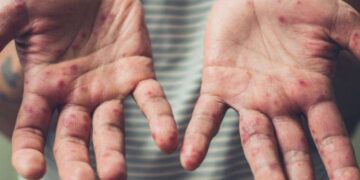 Kızamıkta 'kış' endişesi: Canan Karatay gibiler yüzünden çocuklar aşılatılmıyor