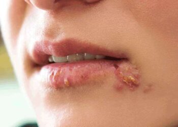 Uzmanı uyardı: Uçuk deyip geçmeyin!