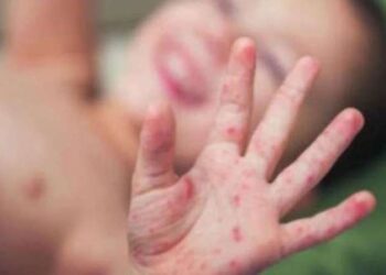 ‘Kızamık vakalarındaki artışın en önemli sebebi aşı karşıtlığı’