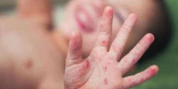 ‘Kızamık vakalarındaki artışın en önemli sebebi aşı karşıtlığı’