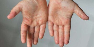 Uzmanlar uyarıyor: Kızamık salgınına dikkat!