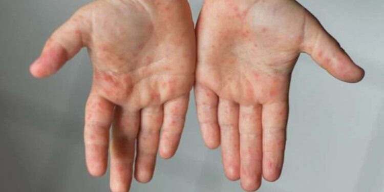 ‘Kızamıktan korunmada en etkili yöntem aşı yaptırmak’