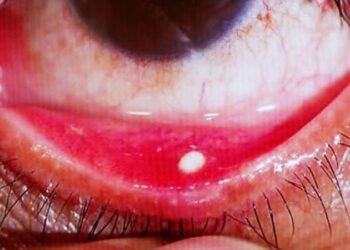 Uzmanı uyardı: Gözünüzde batma varsa dikkat!