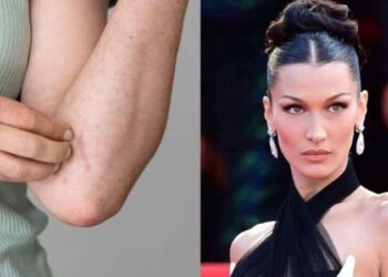 Lyme hastalığı nedir? Bella Hadid’in hastalığı Lyme’nin belirtileri nedir? Lyme hastalığının tedavisi var mı?