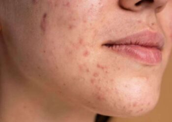 Uzmanından leke ve ben uyarısı