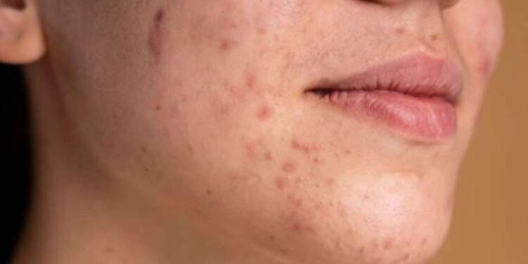 Uzmanından leke ve ben uyarısı