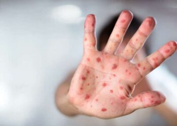 Uzmanından ‘kızamık virüsü’ hakkında uyarılar