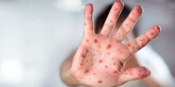 Uzmanından ‘kızamık virüsü’ hakkında uyarılar