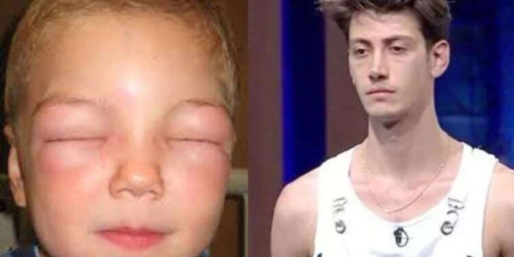 Herediter Anjioödem nedir? Herediter Anjioödem belirtileri nelerdir? Herediter Anjioödem nasıl tedavi edilir?