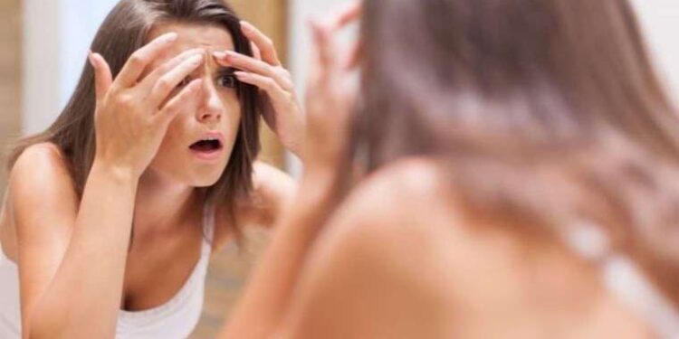 Sivilcelerinizden bir günde kurtulun! Sivilcelerden kurtulmanın doğal yolu!