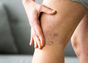 Varise karşı evde uygulayabileceğiniz yöntem: 1 bardağı yeterli oluyor… Hepsini yok edin