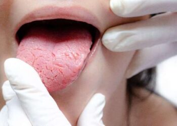 Dilinizi çıkarın ve rengine bakın! Diliniz bu renkse kalbiniz yeterli çalışmıyor olabilir…