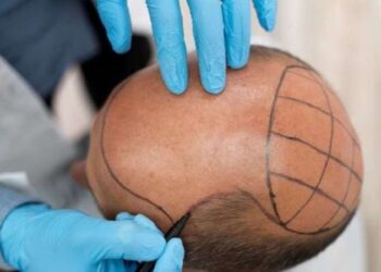 Protez saç nedir, nasıl yapılır? Protez saç ne kadar kalıcı? Protez saç bakımı nasıl olmalı?