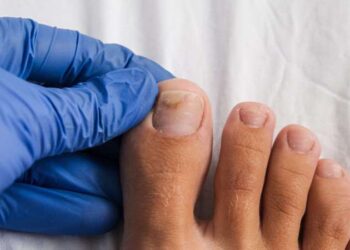 Uzmanların 1 numaralı tavsiyesi: 3 günde tırnak mantarını yok edin