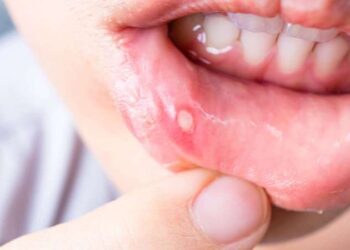 Gününüz aft yaralarından zehir olmasın: Ağız yaralarını 1 saatte geçirin