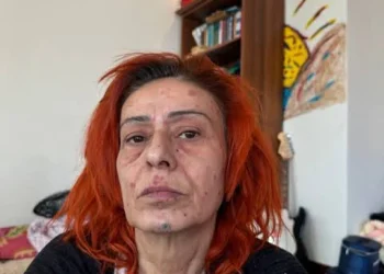 Yıldız Tilbe, saç boyası nedeniyle oluşan yanıkları anlattı