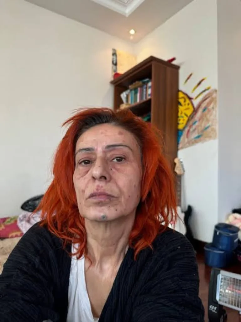 Yıldız Tilbe, saç boyası nedeniyle oluşan yanıkları anlattı