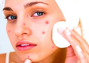 Sivilce Sıkmanın Cilt Sağlığına Zararları: Bilmeniz Gerekenler