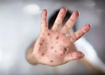 "Kızamık Alarmı: Tekrar Yayılıyor"