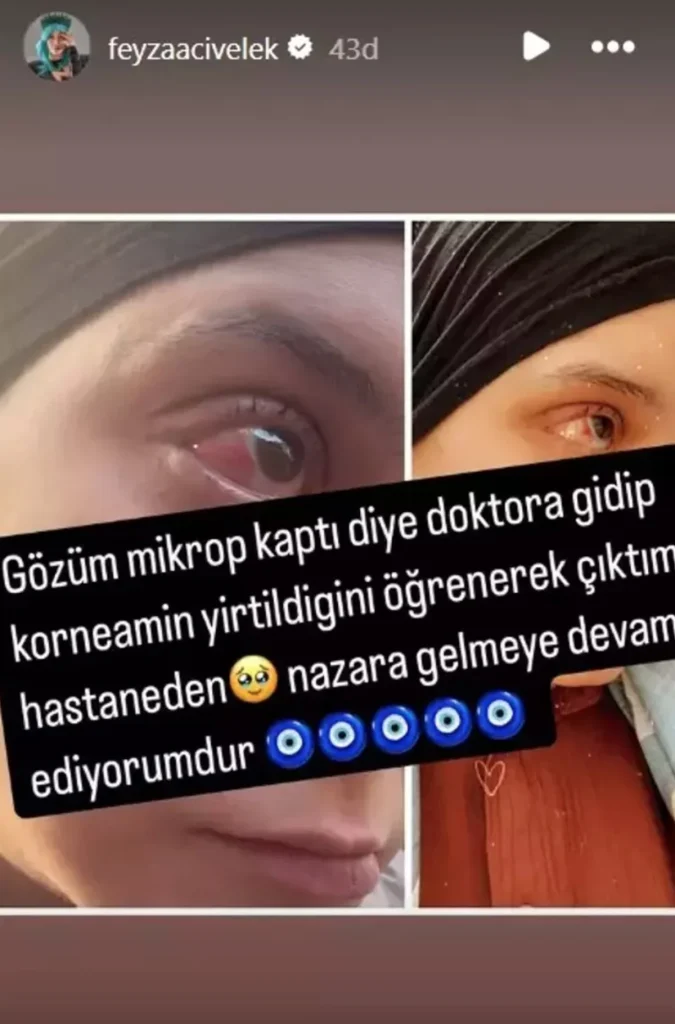 Feyza Civelek'in Gözünde Korkutan Kornea Hasarı