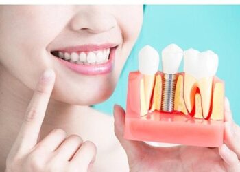 Diş İmplantları Hakkında Bilmeniz Gereken 9 Bilgi!