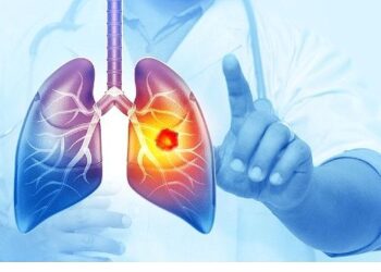 Her Yıl 25 Bin Akciğer Kanseri Vakası Önlenebilir