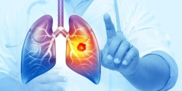 Her Yıl 25 Bin Akciğer Kanseri Vakası Önlenebilir