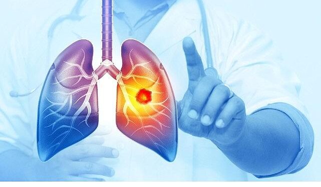 Her Yıl 25 Bin Akciğer Kanseri Vakası Önlenebilir